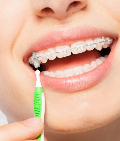 Porselen Diş Telleri